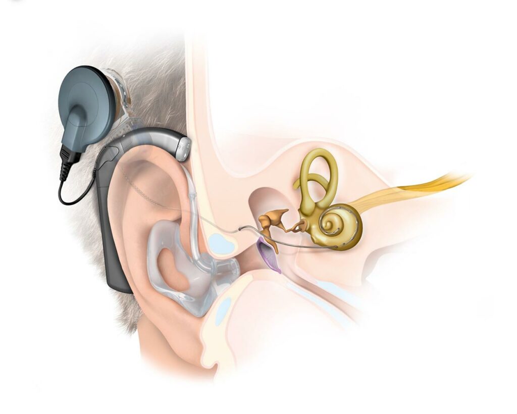 Cochlear Implantat Abbildung